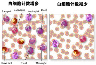 中性粒细胞减少与粒细胞缺乏的诊断标准